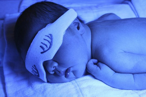 چگونه زردی نوزاد تازه متولد شده را تشخیص دهیم؟ | وب 