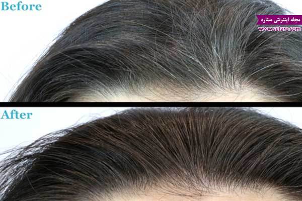 	رفع سفیدی مو با درمان طبیعی و خانگی