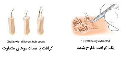 	کاشت مو به روش sut چیست؟ (معایب و مزایا) | وب 