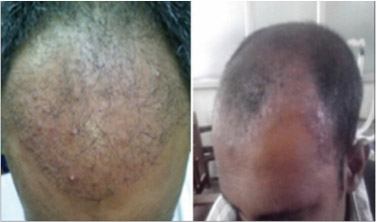 	عوارض جانبی کاشت مو چیست؟ | وب 
