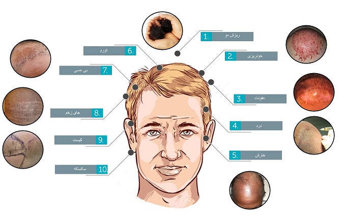 	عوارض جانبی کاشت مو چیست؟ | وب 