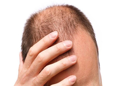 	درمان ریزش مو با 12 روش طبیعی | وب 