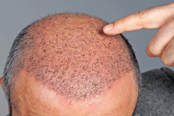 مراقبت‌های پس از کاشت مو؛ باید‌ها و نباید‌ها | وب 