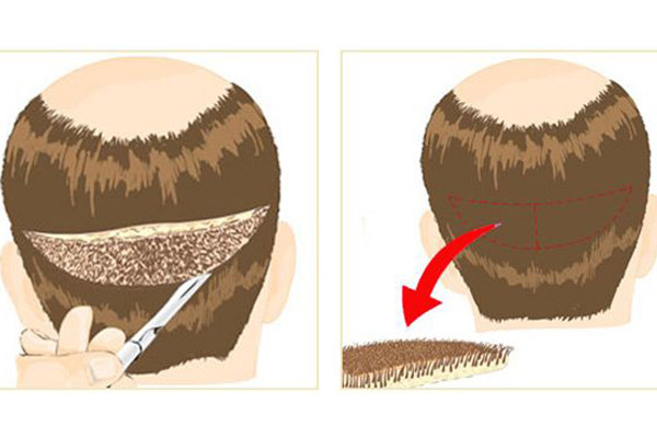 بهترین روش‌ کاشت مو چیست؟ | وب 