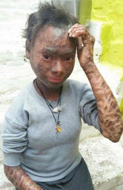 دختری که هر 2 ماه پوست می اندازد! عکس